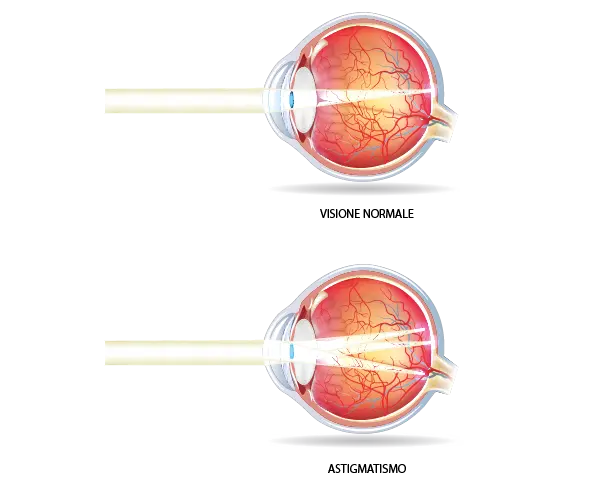 ASTIGMATISMO