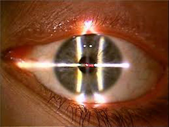 Laser ad eccimeri