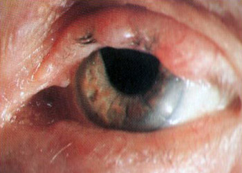 Neurinoma plessiforme