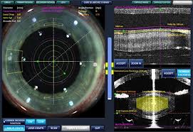 OCT intra operatorio cataratta femtosecond