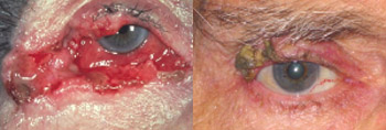 carcinoma a cellule squamose