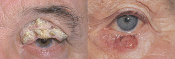 carcinoma basocellulare