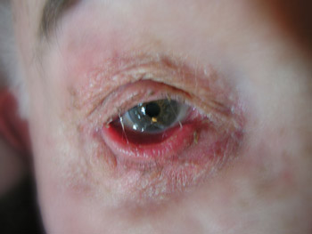ectropion cicatriziale