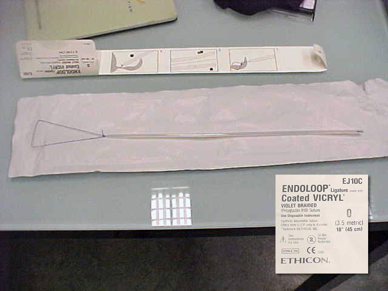 exenteratio orbitae 2