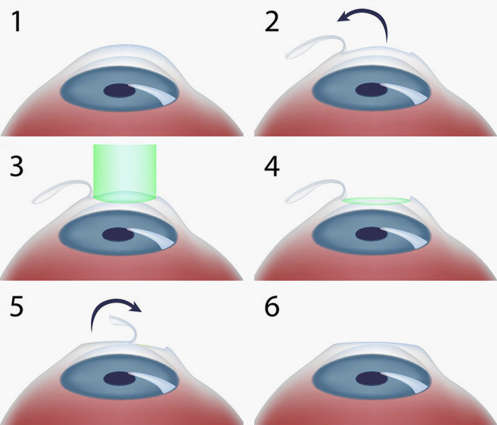 lasik