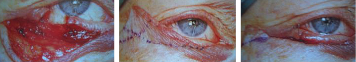 lateral tarsal strip 2