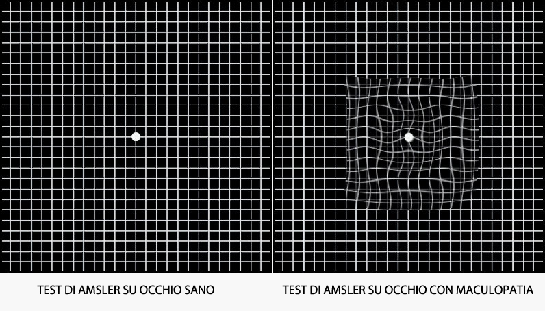 maculopatia test amsler