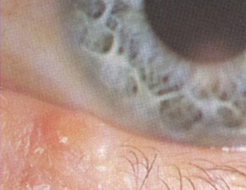 mollusco contagioso