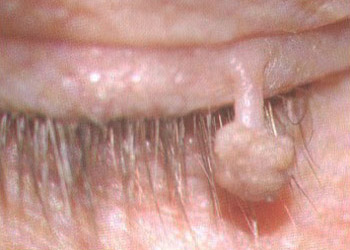 papilloma
