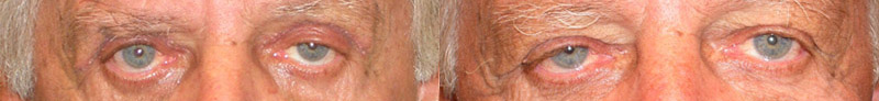 ptosi aponeurotica